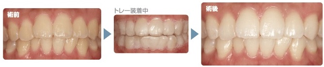 審美歯科・ホワイトニング | 香芝市・五位堂駅のいのうえ歯科クリニック